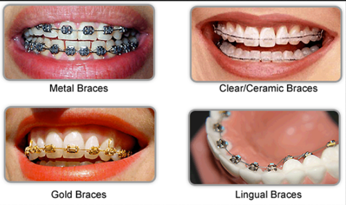 braces-4