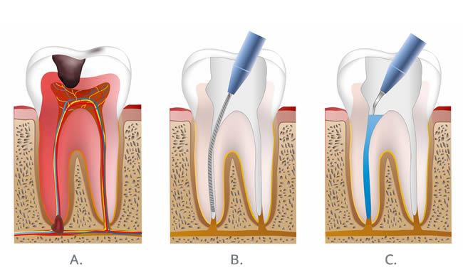 root-step