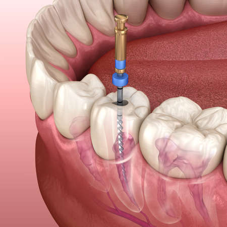 Best Root canal Treatment in karaikudi