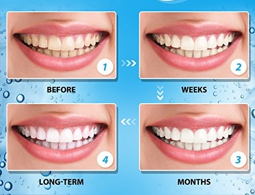 Best Teeth Whitening Treatment