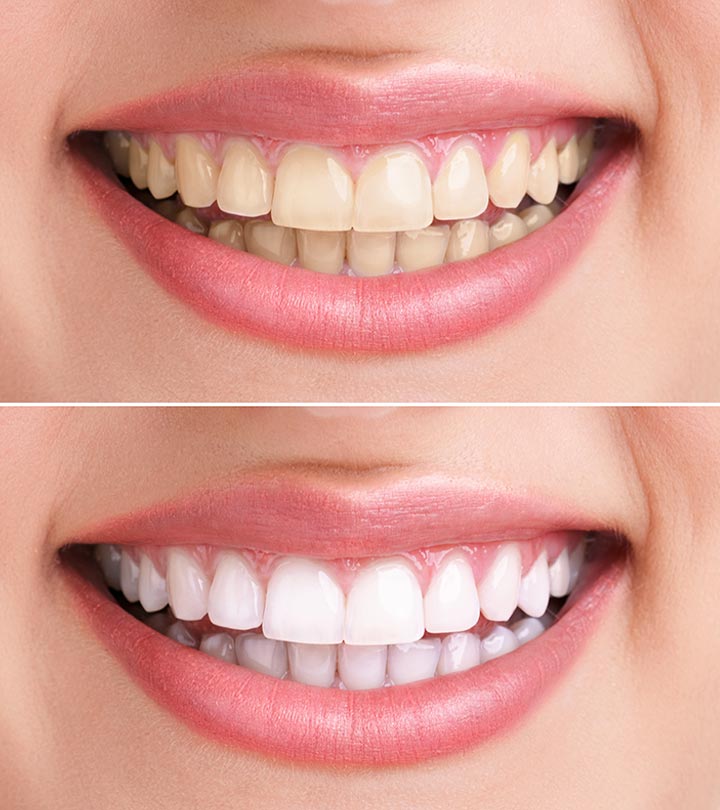 Best Teeth Whitening Treatment in karaikudi